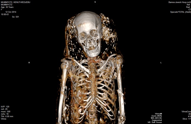 A CT scan of the mummy Henut-Wedjebu, an Egyptian noblewoman who lived during 1300 BC. The specks around her head might be beads that were part of a headdress. Henut-Wedjebu and two younger male mummies are on display at the St. Louis Art Museum. She and one of the others are on loan from the Kemper Art Museum at Washington University. Credit: Washington University Mallinckrodt Institute of Radiology