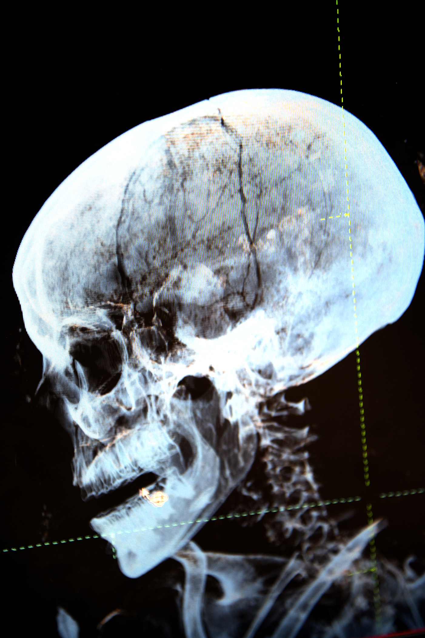 Henut-Wedjebu's intact brain is visible in blue. Credit: Washington University Mallinckrodt Institute of Radiology