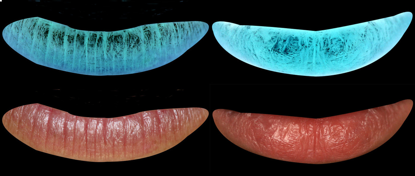 Left: A straight and vertical lip print pattern on a lower lip, pictured in high contrast (top) and in true color (bottom). Right: A whorl pattern on a lower lip, pictured in high contrast (top) and in true color (bottom). This individual did not have oral cleft.