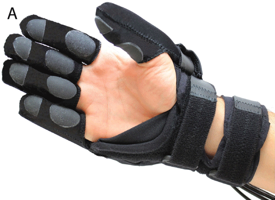 The prototyped soft robotic glove for users with hand impairments. The range of motion that can be achieved is shown here. Credit: Panagiotis Polygerinos