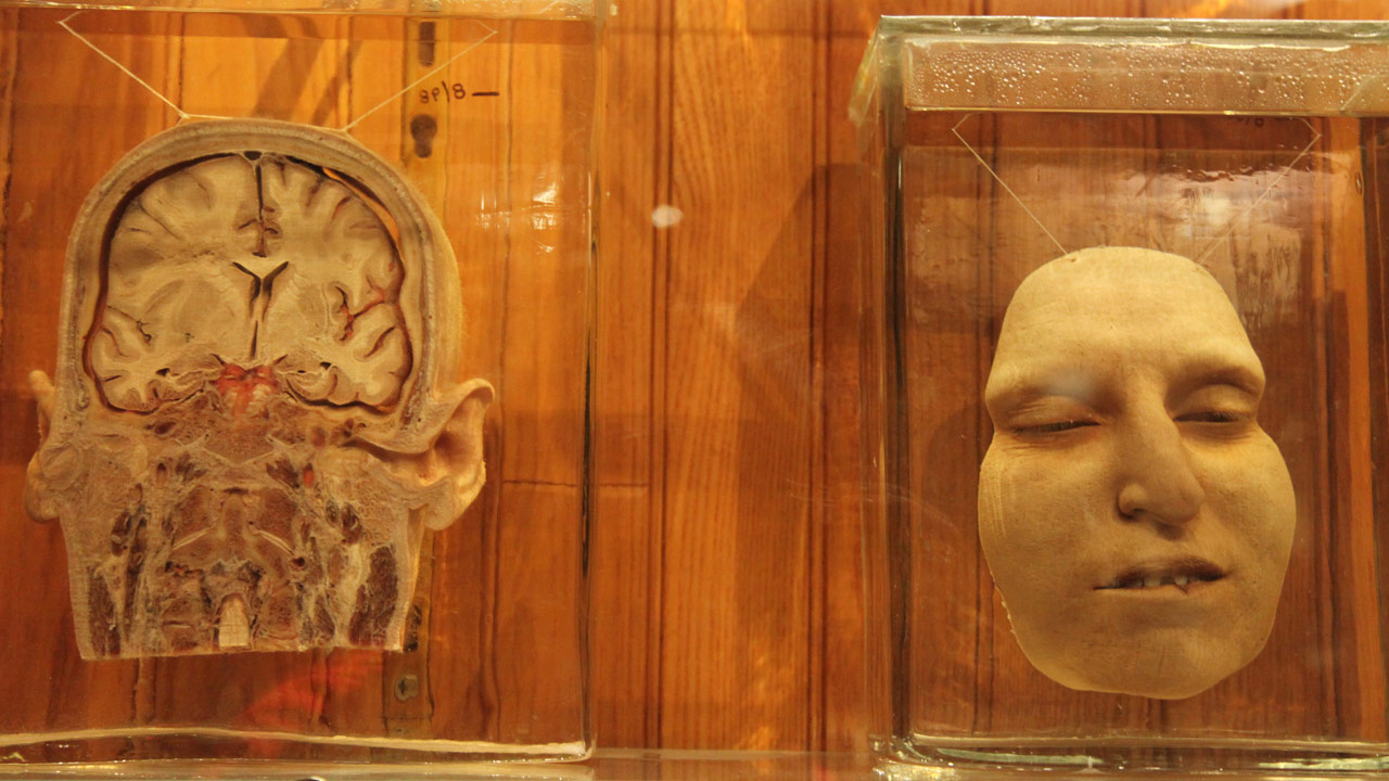 Medical Oddities from the Bowels of the Mütter - Science Friday