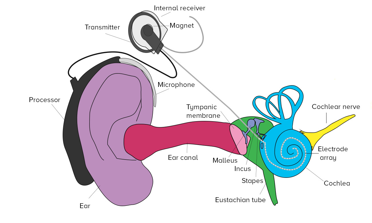 speech recognition test cochlear implants