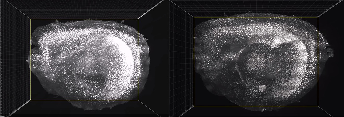 two brain scans side by side. the one on the left has a lot of white dense dots in the scan, while the one on the right has much less white spots. you can see a lot more empty space