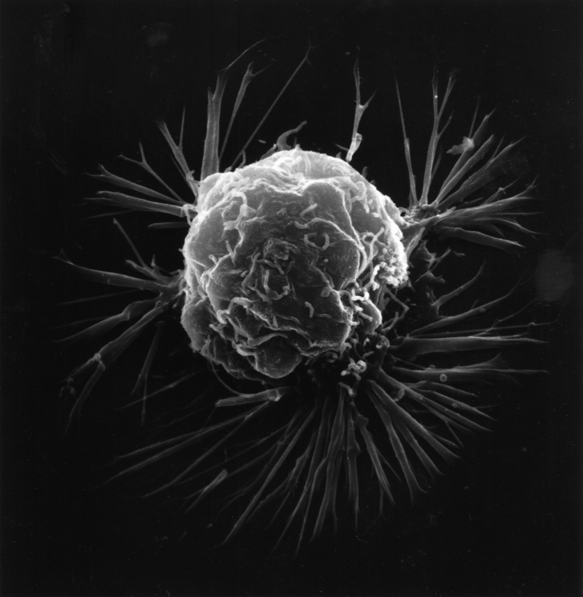 a black and white image of a breast cancer cell, photographed by a scanning electron microscope. it's a 3D image of a round bumpy cell, with binding sites coming off it 