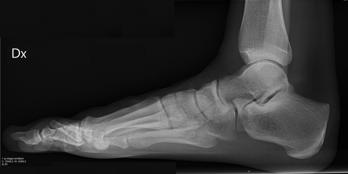 a black and white x-ray of a foot and ankle. you can see where the bones meet and where the joints are