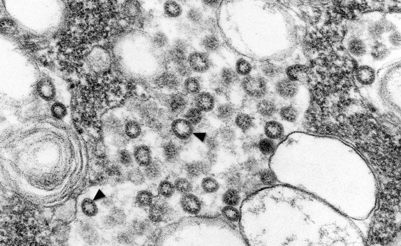 a black and white microscope image that shows many circles. smaller circles with thick black edges (the corona) are the SARS coronavirus.