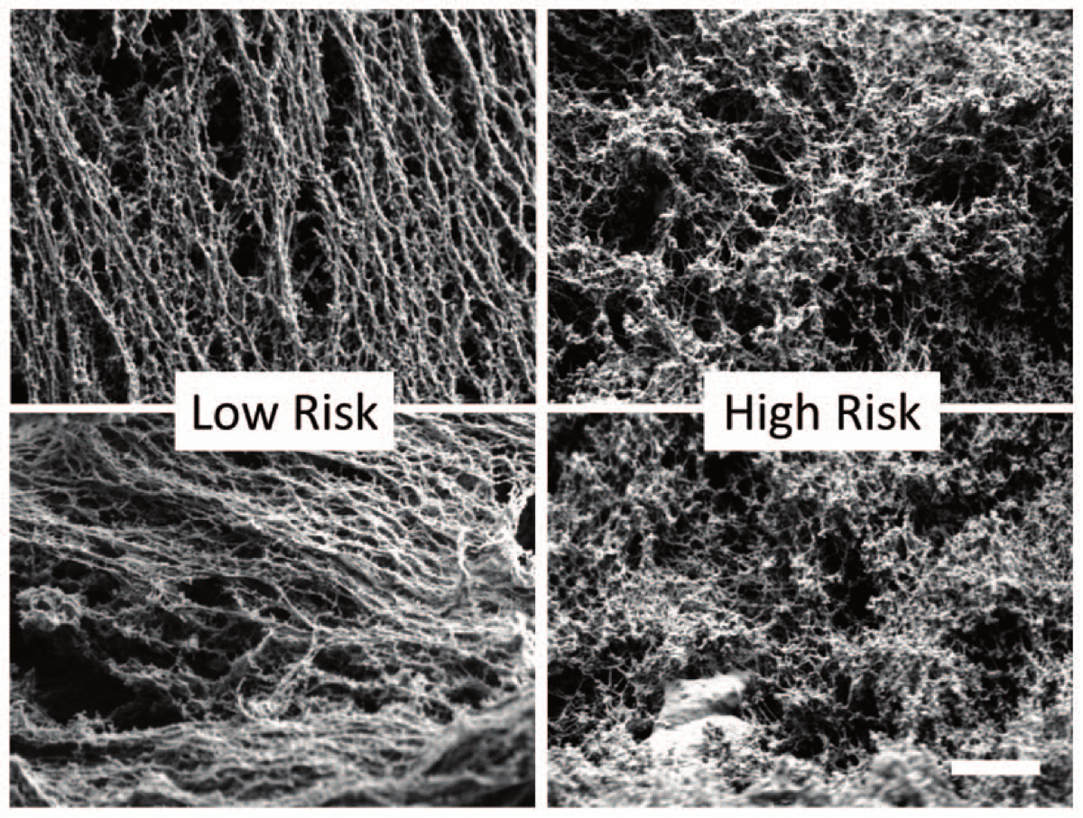 four images compiled together. the left two show mucus from those at low risk of preterm labor. these images reveal more uniform filamentous material. on the right is mucus from those high at risk for preterm labor. these images show network of mucin that is more patchy and globed together.