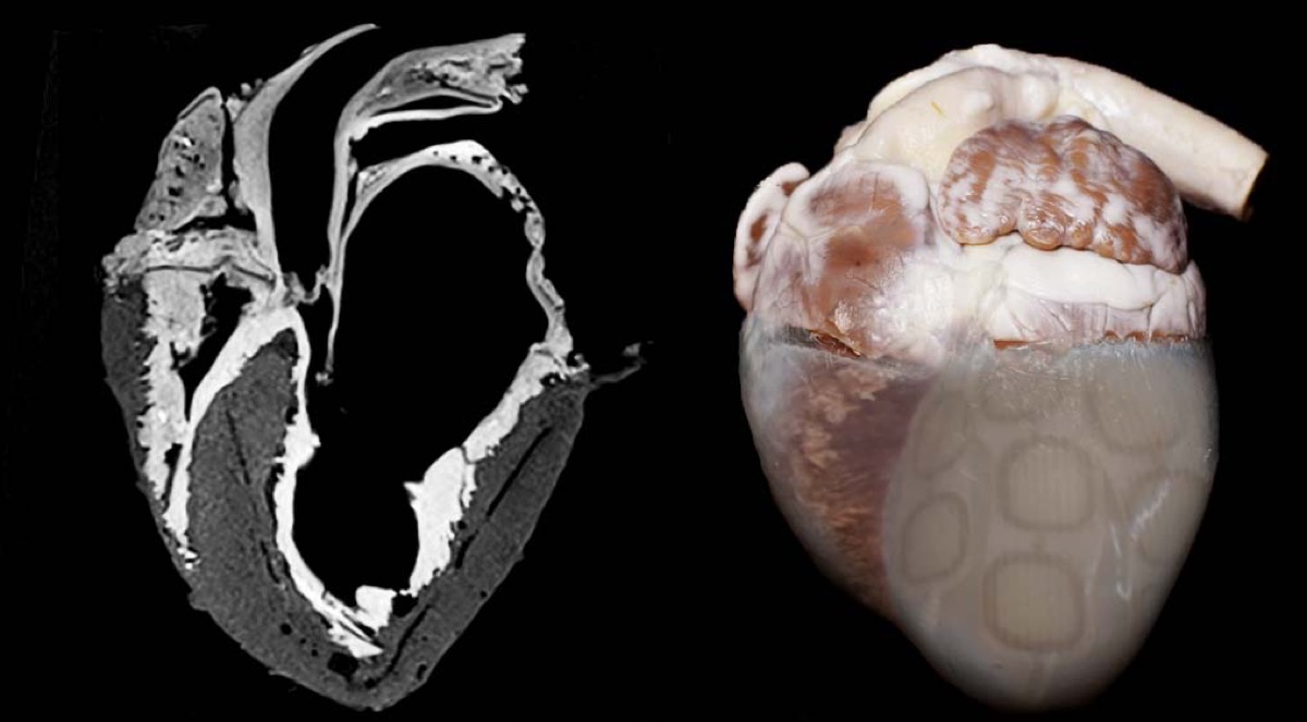 two hearts. on the left is an x-ray version that reveals the valves. on the right is a color photo of the heart, with some patchwork on the right corner