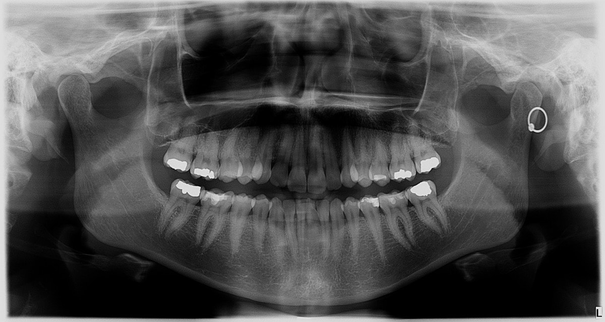 a full panorama x-ray of a person's mouth which reveals teeth, roots, and fillings