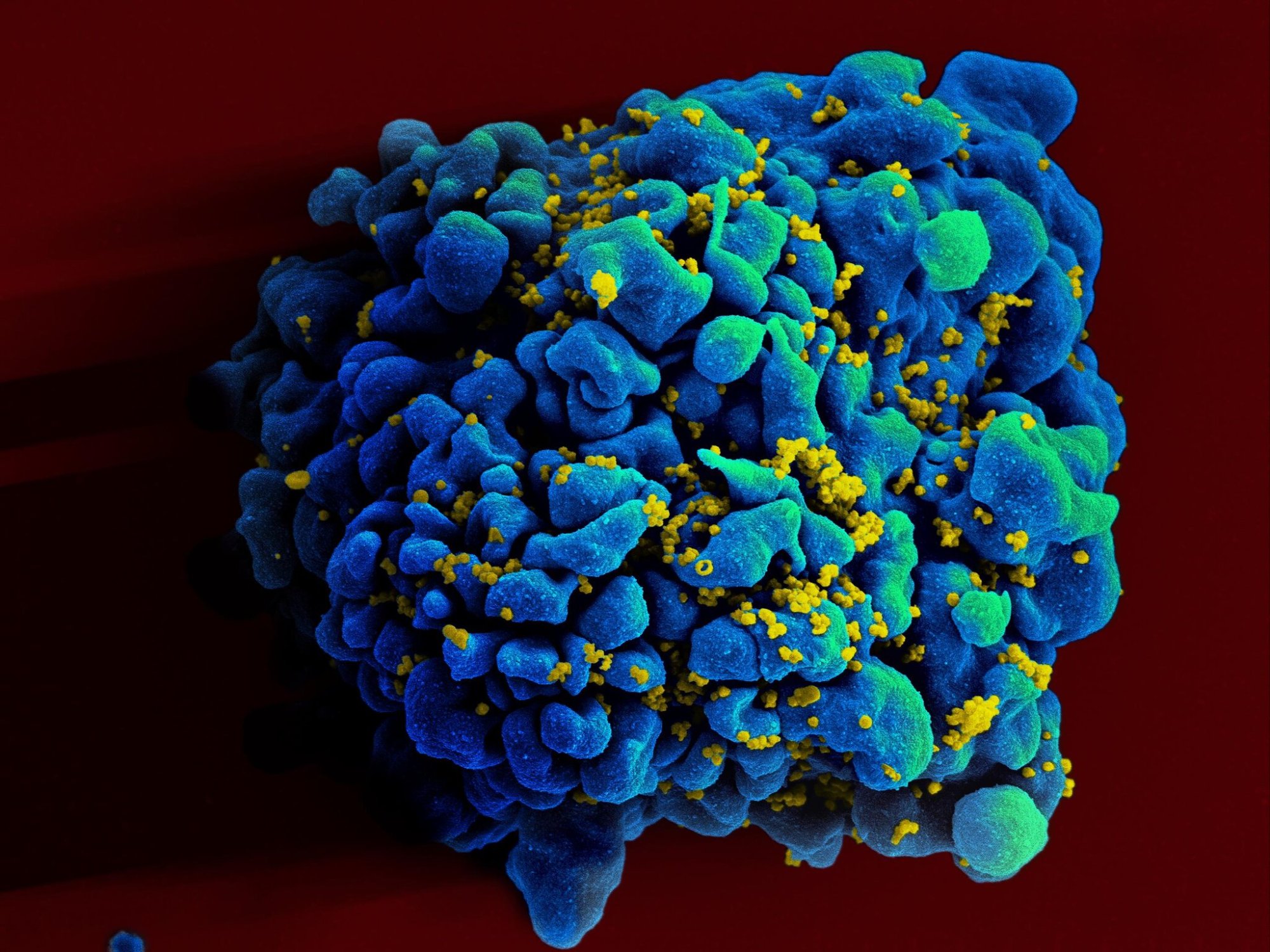 a bumpy cell with specks of yellow, representing hiv