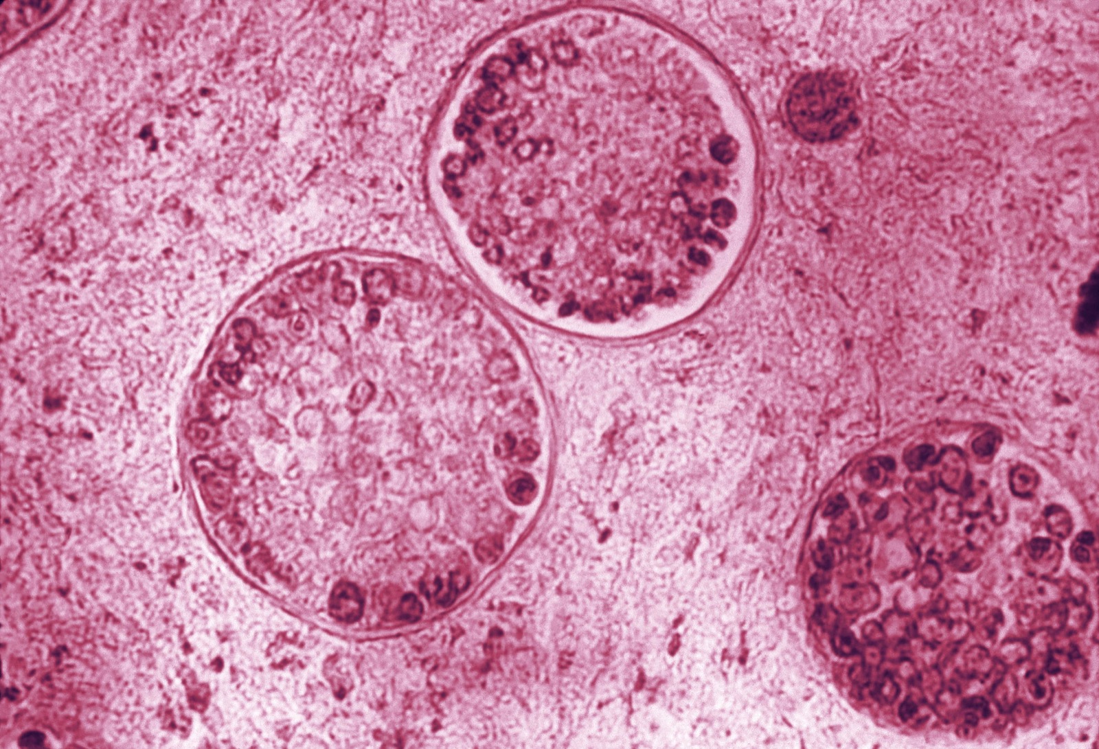 a microscope image of fungal spheres sliced in half, showing the spores growing inside. this is a granuloma growing in the lungs