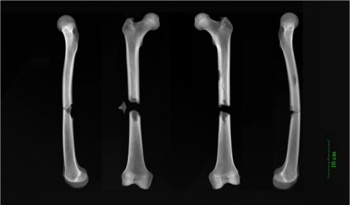 black and white image of x-ray scans of femur bones in different views. each of the bones have a fracture or are broken in the middle