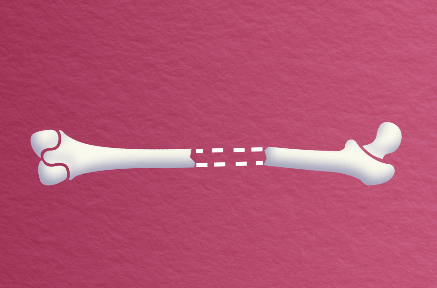 Break bone. Break bone. Кости. Фото самого который сломал кости человека в мире-. Кость d3.