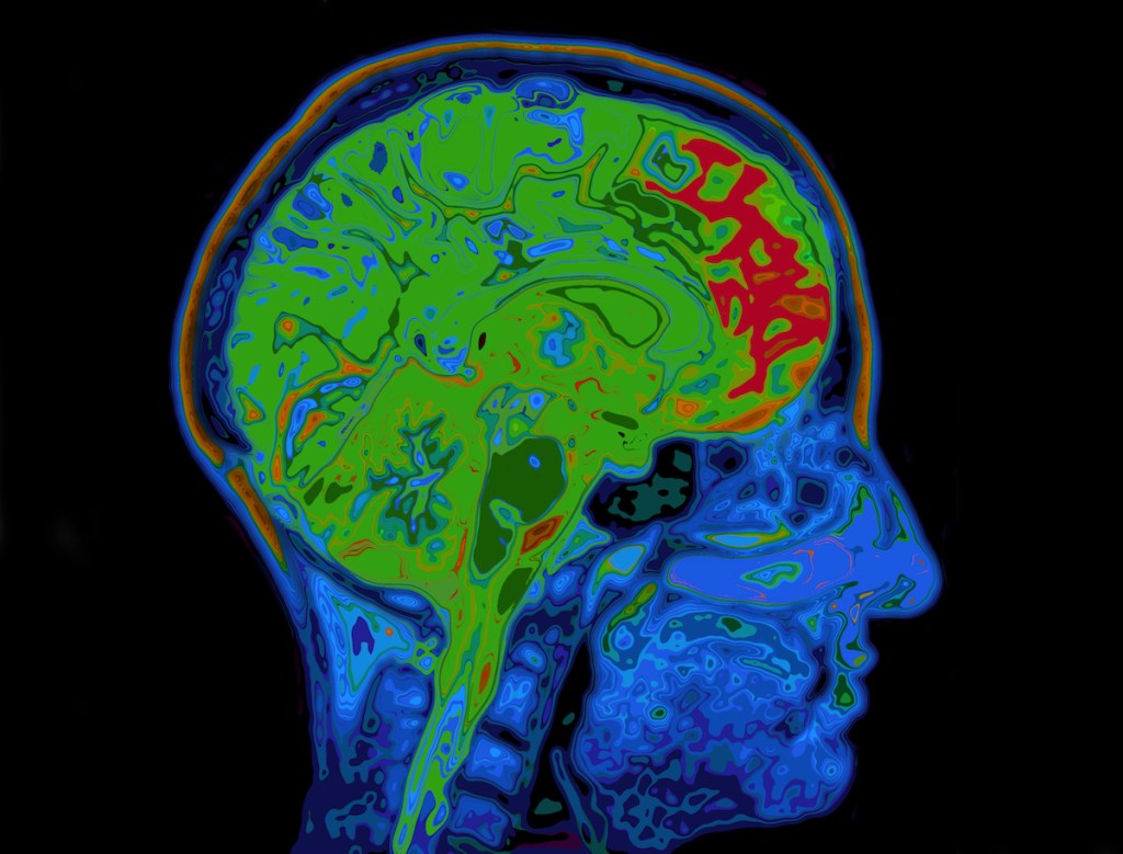 MRI image of head showing the brain