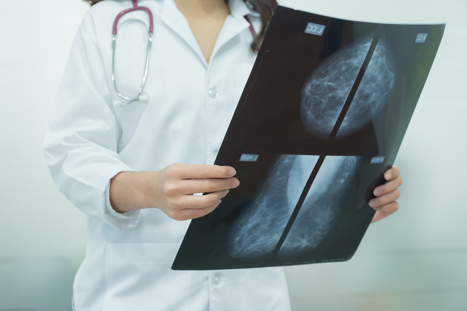 a doctor in a white coat with a stethescope around their neck, pictured from the neck down, holds a large black xray sheet depicting the results of a mammogram