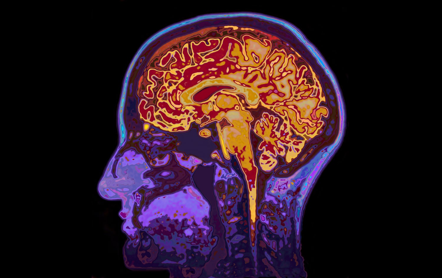 a side profile view of a human brain scan, colored in orange and purple. you can see the various lobes and folds of the brain