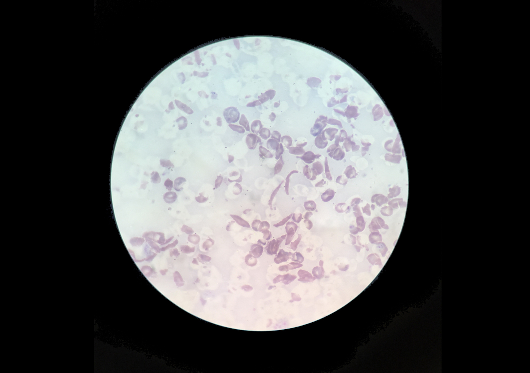 Blood cells floating under a microscope view. Some look broken and stripped.