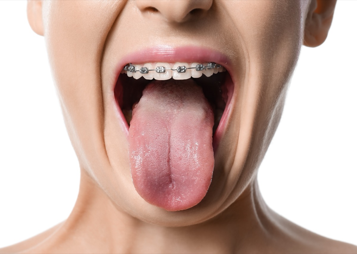 A person with dental braces shows their tongue.