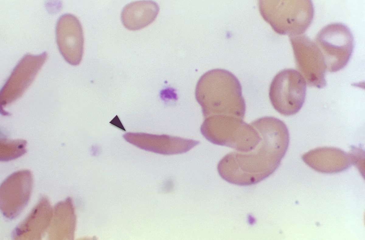 A few pale purple blood cells against a white background. One of the cells is elongated with a curved edge, otherwise known as a "sickle" shape.