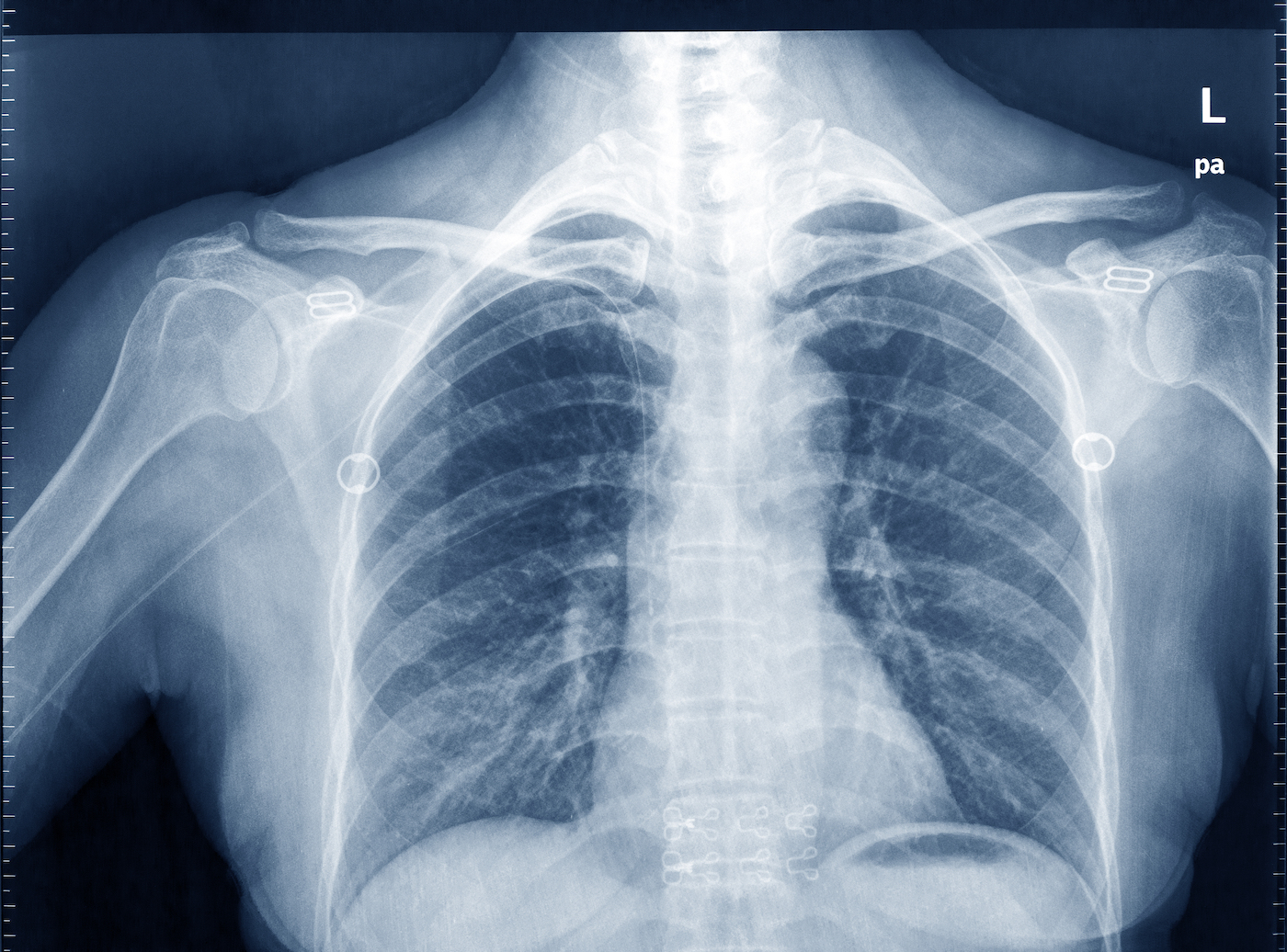 Using AI to Predict Heart Disease from Chest X-Rays
