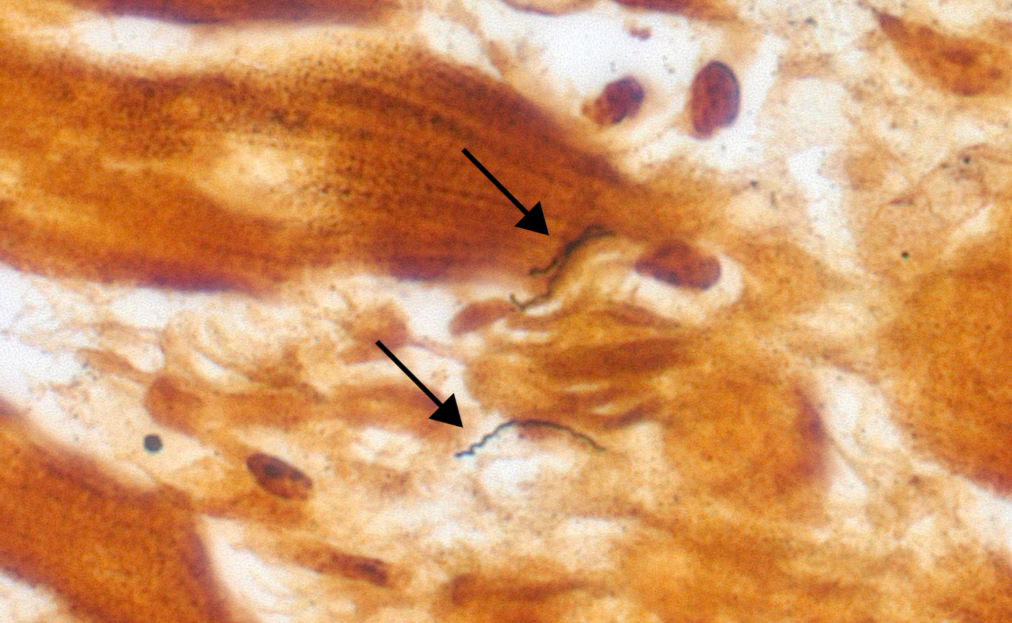 Murky brown and white tissue with two arrows pointing to long, black, squiggly lines that are bacteria.