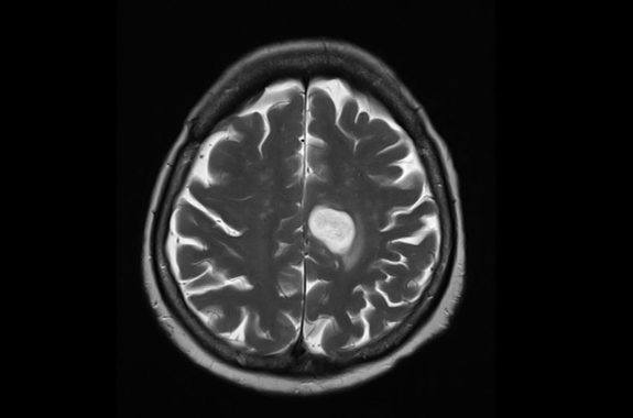 An axial cut magnetic resonance image or MRI of brain showing a large tumor in the brain.