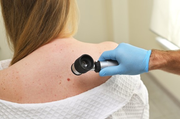 A mole on a white woman's back is being examined by a doctor.
